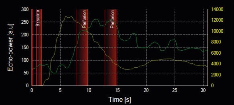 Time windows selection on dual-scale graph, showing TIC from plaque and vascular lumen